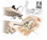 Оборудование для артроскопии малых суставов ENDO-CARTRIS