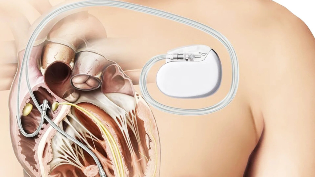 kardiostimulyatory.jpeg kardiostimulyatory.jpeg