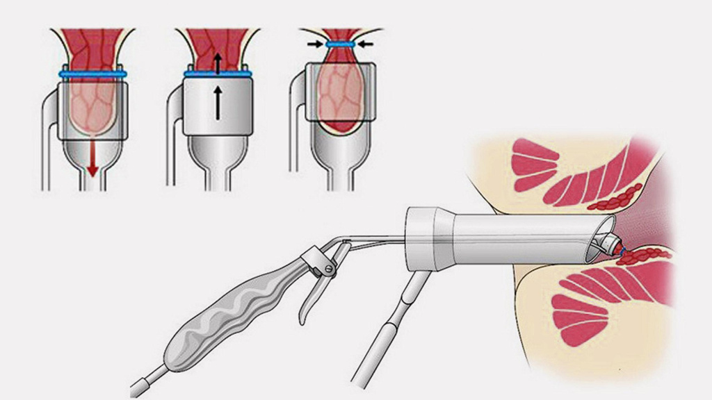 anoskopy.jpg anoskopy.jpg